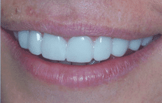 Snap on smile és un tractament innocu i no invasiu d'estètica dental. Consisteix en unes fèrules estèti-ques de treure i posar. Clínica Dental Padrós és un centre certificat per l'aplicació de Snap on smile a Barcelona Snap on smile és un tractament innocu i no invasiu d'estètica dental. Consisteix en unes fèrules estèti-ques de treure i posar. Clínica Dental Padrós és un centre certificat per l'aplicació de Snap on smile a Barcelona