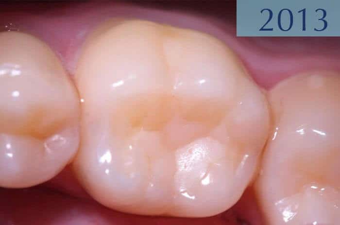 Empastament dental 16 anys més tard, realitzat en l'any 1997 a la Clínica Dental Padrós en un tractament de càries dental Empastament dental 16 anys més tard, realitzat en l'any 1997 a la Clínica Dental Padrós en un tractament de càries dental