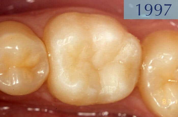 Empastament dental realitzat en l'any 1997 a la Clínica Dental Padrós en un tractament de càries dental Empastament dental realitzat en l'any 1997 a la Clínica Dental Padrós en un tractament de càries dental