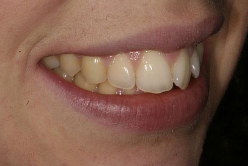Analitzant mostres de casos pràctics del tractament d'ortodòncia ràpida a Barcelona Inman Aligner. A la imatge s'observa la posició de les dents en un dels pacients tractats a la nostra clínica dental abans d'haver-se sotmès al tractament.