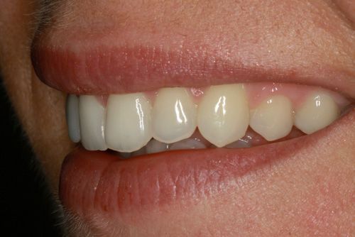 Analitzant mostres de casos pràctics del tractament d'ortodòncia ràpida a Barcelona Inman Aligner. A la imatge s'observa la posició de les dents en un dels pacients tractats a la nostra clínica dental després d'haver-se sotmès al tractament.