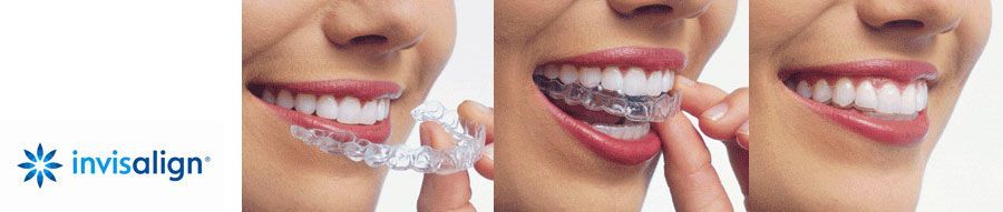 La clínica dental Padrós a Barcelona disposa del tractament d'ortodòncia invisible invisalign, aparells transparents i extraïbles La clínica dental Padrós a Barcelona disposa del tractament d'ortodòncia invisible invisalign, aparells transparents i extraïbles