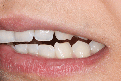 El bruxisme és el tercer trastorn del son més comú. Un de cada quatre persones el pateixen. El rechinamiento o apretament de les dents provoca dolor mandibular, mal de cap, etc. El bruxisme és el tercer trastorn del son més comú. Un de cada quatre persones el pateixen. El rechinamiento o apretament de les dents provoca dolor mandibular, mal de cap, etc.