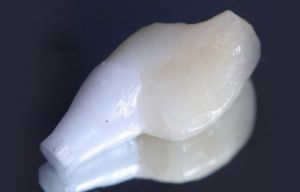 Exemple d'un cas real tractat a la Clínica Dental Padrós de tractament d'implants dentals. A la imatge podem observar l'implant dental utilitzat abans de la col·locació a la boca del pacient.