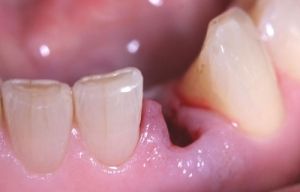 Exemple d'un cas real tractat a la Clínica Dental Padrós abans de procedir al tractament d'implants dentals