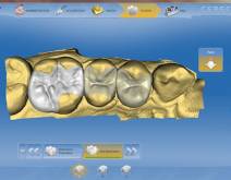 Imatges d'un cas real en clínica dental Padrós amb el sistema CEREC CAD-CAM. Amb l'ús del programari de disseny podem millorar el disseny i creació de restauracions dentals, especialment pròtesis dentals incloent corones, caretes, ponts, implants i aparells d'ortodòncia Imatges d'un cas real en clínica dental Padrós amb el sistema CEREC CAD-CAM. Amb l'ús del programari de disseny podem millorar el disseny i creació de restauracions dentals, especialment pròtesis dentals incloent corones, caretes, ponts, implants i aparells d'ortodòncia