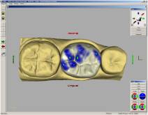 Imatges d'un cas real en clínica dental Padrós amb el sistema CEREC CAD-CAM. Amb l'ús del programari de disseny podem millorar el disseny i creació de restauracions dentals, especialment pròtesis dentals incloent corones, caretes, ponts, implants i aparells d'ortodòncia Imatges d'un cas real en clínica dental Padrós amb el sistema CEREC CAD-CAM. Amb l'ús del programari de disseny podem millorar el disseny i creació de restauracions dentals, especialment pròtesis dentals incloent corones, caretes, ponts, implants i aparells d'ortodòncia