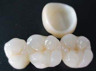 Amb l'ús del programari de disseny CAD-CAM podem millorar el disseny i creació de restauracions dentals, especialment pròtesis dentals incloent corones, caretes, ponts, implants i aparells d'ortodòncia Amb l'ús del programari de disseny CAD-CAM podem millorar el disseny i creació de restauracions dentals, especialment pròtesis dentals incloent corones, caretes, ponts, implants i aparells d'ortodòncia