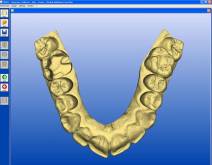 Imatges d'un cas real en clínica dental Padrós amb el sistema CEREC CAD-CAM. Amb l'ús del programari de disseny podem millorar el disseny i creació de restauracions dentals, especialment pròtesis dentals incloent corones, caretes, ponts, implants i aparells d'ortodòncia Imatges d'un cas real en clínica dental Padrós amb el sistema CEREC CAD-CAM. Amb l'ús del programari de disseny podem millorar el disseny i creació de restauracions dentals, especialment pròtesis dentals incloent corones, caretes, ponts, implants i aparells d'ortodòncia