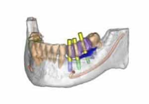 El nostre sistema de radiologia 3D Simplant ens permet programar els casos de tractaments d'implants dentals amb gran precisió. Podem realitzar cirurgies virtuals, preparar plantilles, conèixer la densitat de l'os en cada punt, etc. El nostre sistema de radiologia 3D Simplant ens permet programar els casos de tractaments d'implants dentals amb gran precisió. Podem realitzar cirurgies virtuals, preparar plantilles, conèixer la densitat de l'os en cada punt, etc.
