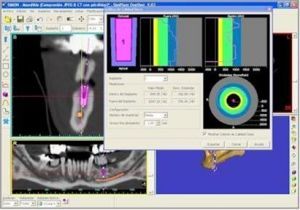 El nostre sistema de radiologia 3D Simplant ens permet programar els casos de tractaments d'implants dentals amb gran precisió. Podem realitzar cirurgies virtuals, preparar plantilles, conèixer la densitat de l'os en cada punt, etc. El nostre sistema de radiologia 3D Simplant ens permet programar els casos de tractaments d'implants dentals amb gran precisió. Podem realitzar cirurgies virtuals, preparar plantilles, conèixer la densitat de l'os en cada punt, etc.