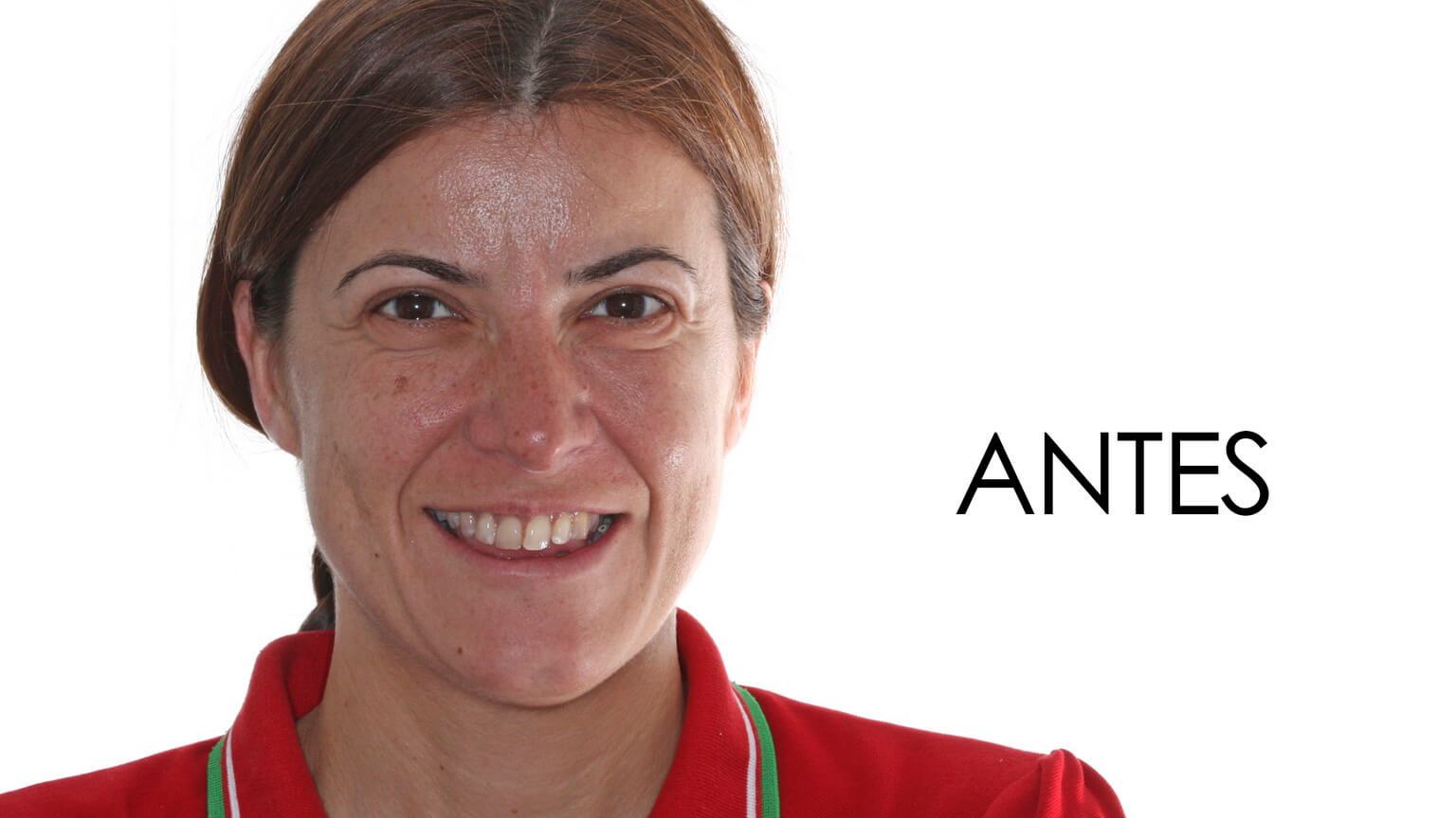 Abans de l'estudi d'estètica dental i el tractament d'ortodòncia Abans de l'estudi d'estètica dental i el tractament d'ortodòncia