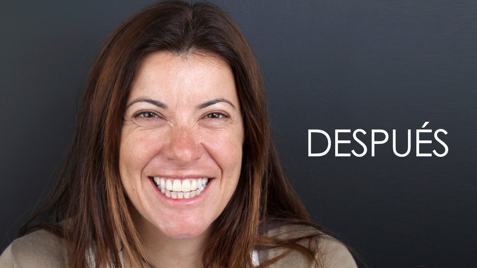 Després de l'estudi d'estètica dental i el tractament d'ortodòncia Després de l'estudi d'estètica dental i el tractament d'ortodòncia