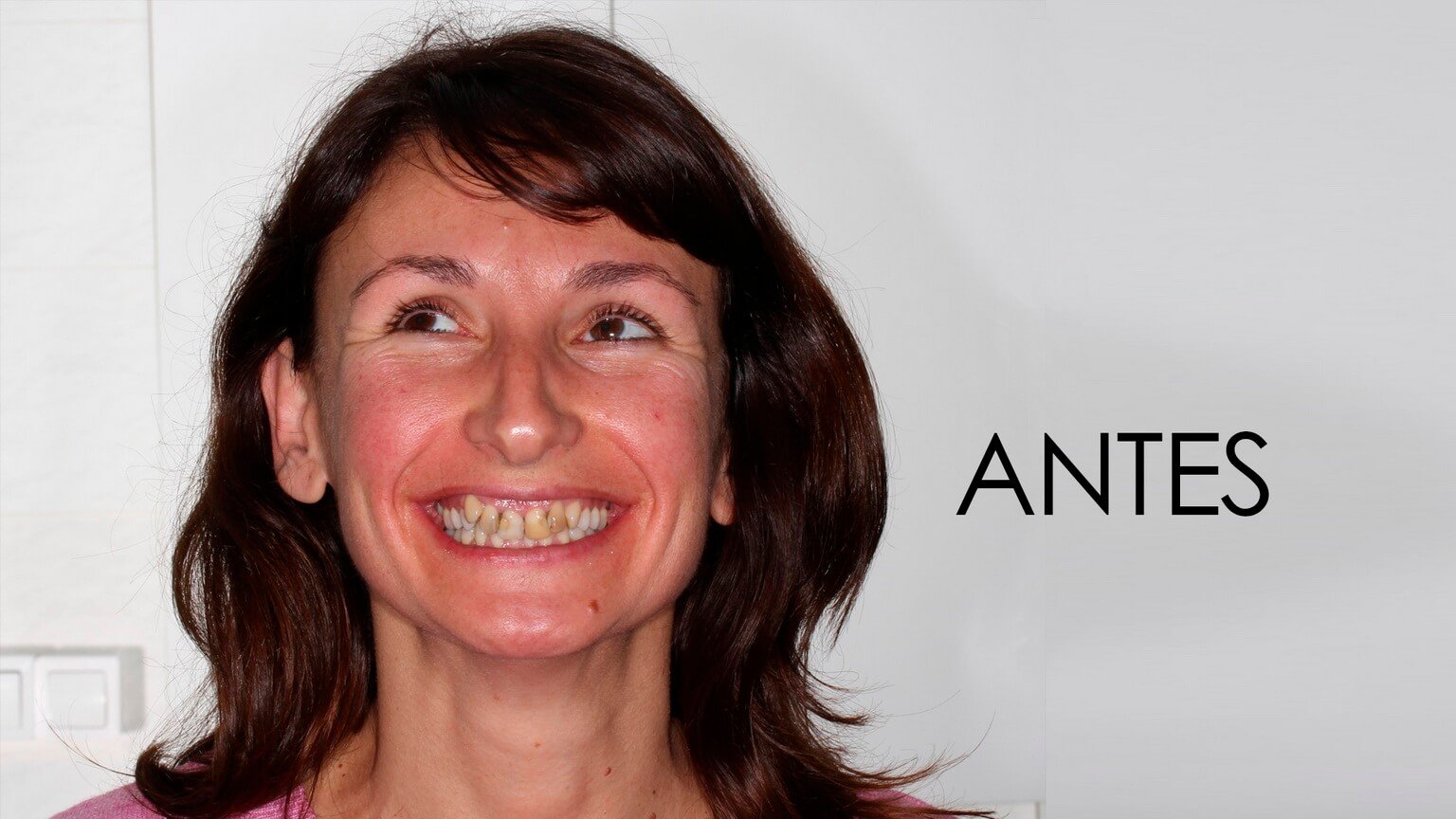 Abans de l'estudi d'estètica dental i el tractament d'ortodòncia Abans de l'estudi d'estètica dental i el tractament d'ortodòncia