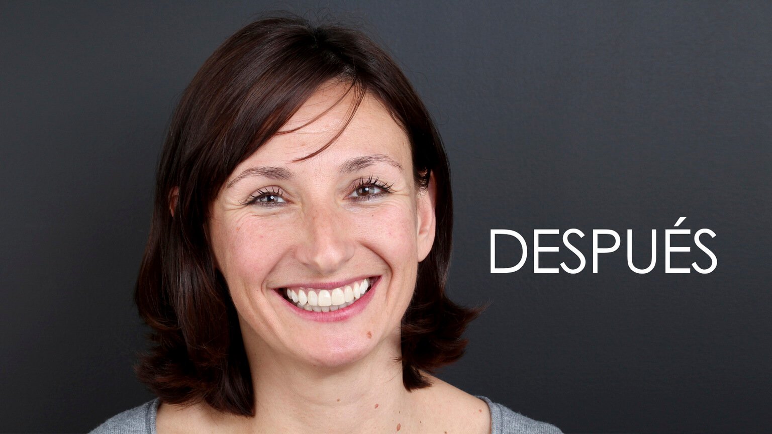 Després de l'estudi d'estètica dental i el tractament d'ortodòncia Després de l'estudi d'estètica dental i el tractament d'ortodòncia