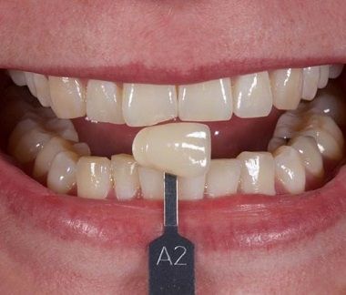 Abans del tractament d'estètica emblanquiment dental. Clínica dental Padrós, dentista a Barcelona