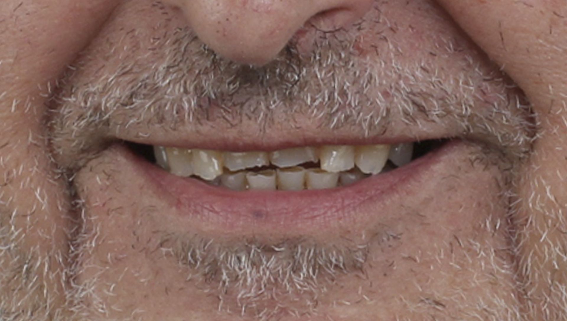 Abans del tractament d'implants dentals