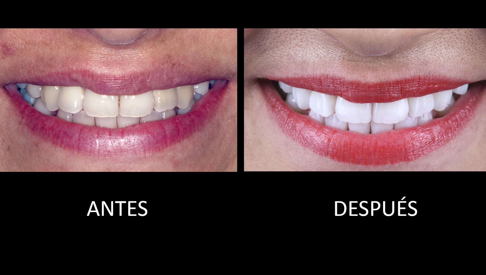 Abans i després del tractament de blanquejament dental Abans i després del tractament de blanquejament dental