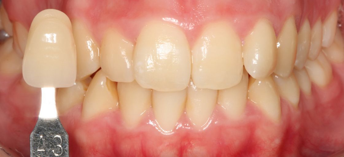 Abans del tractament d'estètica emblanquiment dental. Clínica dental Padrós, dentista a Barcelona