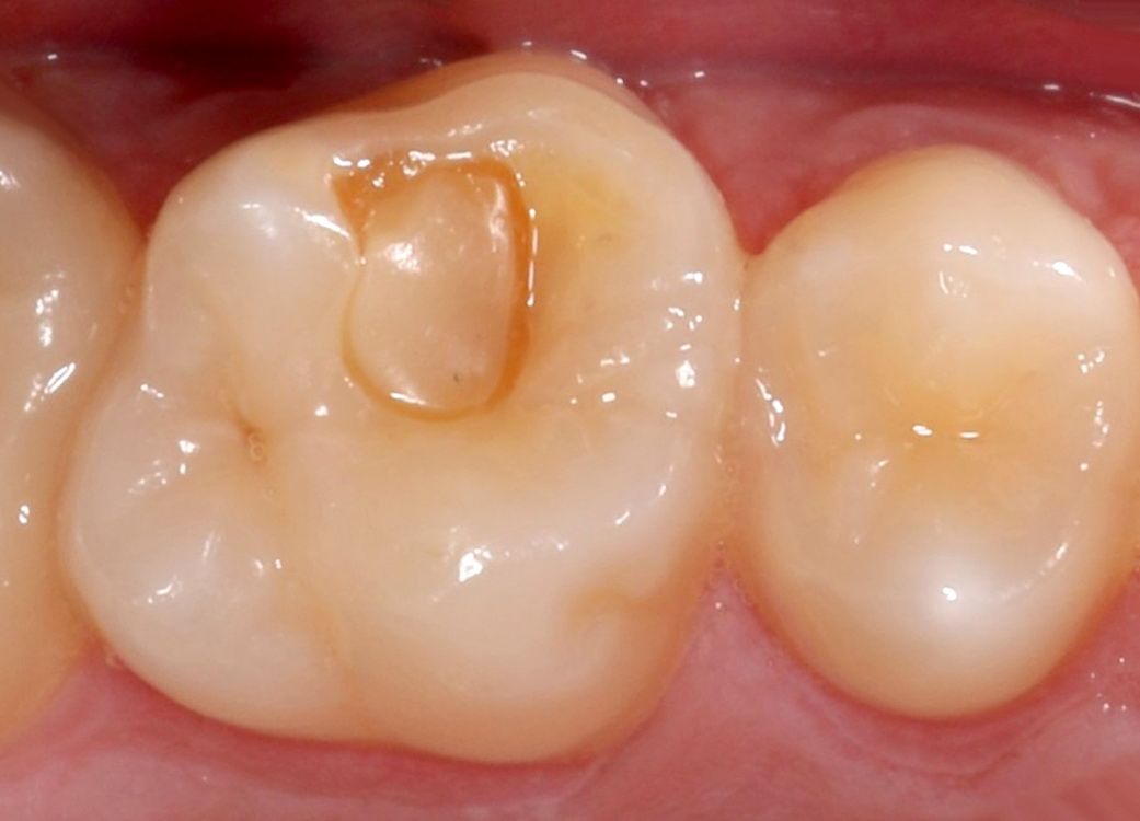 Abans del reemplaçament d'un empastament dental defectuós per un nou estratificat de llarga durada. La reconstrucció resulta gairebé imperceptible.