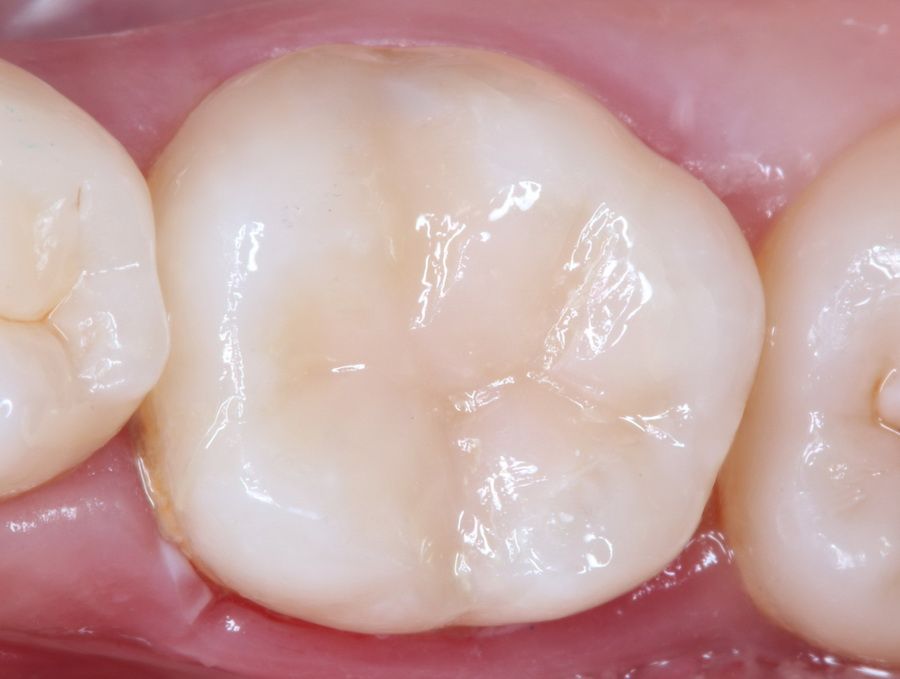 El Carisolv permet dissoldre de manera molt controlada i conservadora el teixit dental amb càries, respectant els teixits dentals sans