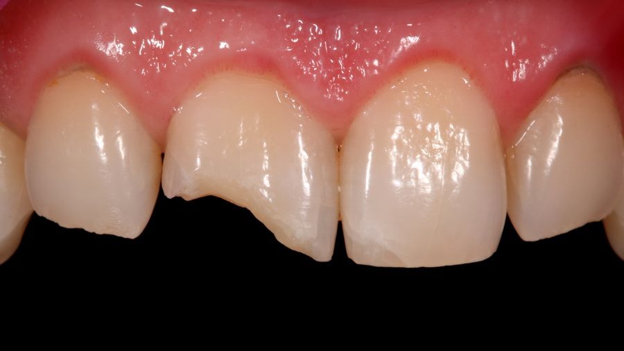 Tractament de reconstrucció de dents en clínica dental Padrós. El teu dentista a Barcelona