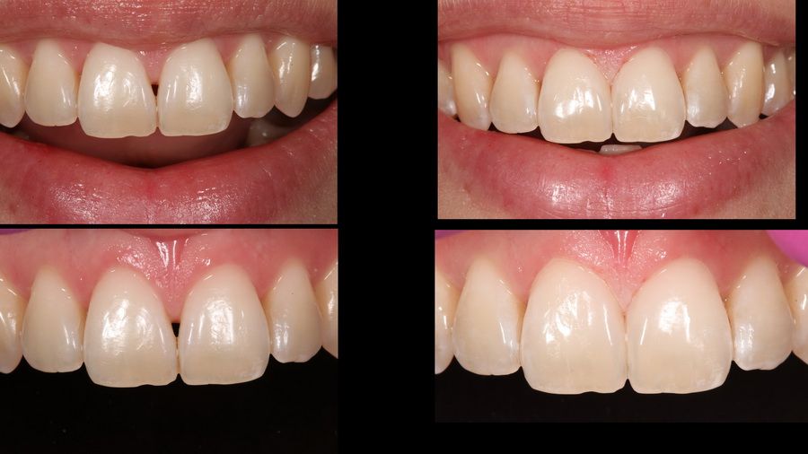 Tractament de reconstrucció de dents en clínica dental Padrós. El teu dentista a Barcelona