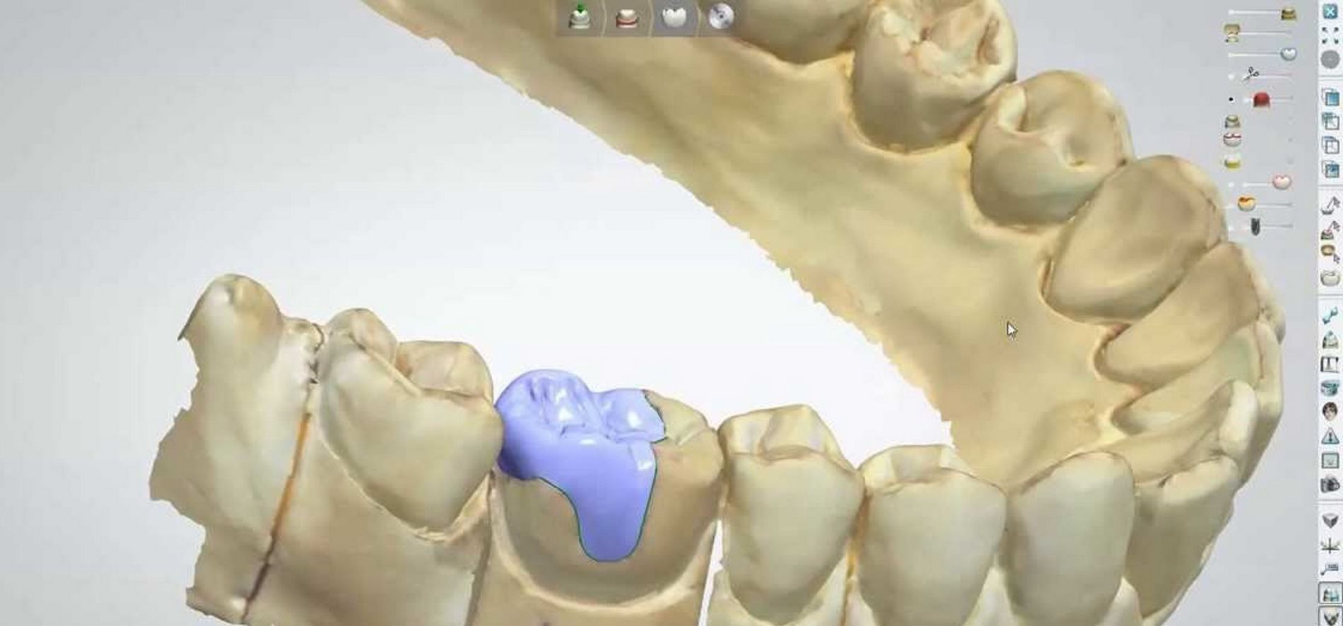Imatges d'un cas real en clínica dental Padrós amb el sistema CEREC CAD-CAM. Amb l'ús del programari de disseny podem millorar el disseny i creació de restauracions dentals, especialment pròtesis dentals incloent corones, caretes, ponts, implants i aparells d'ortodòncia