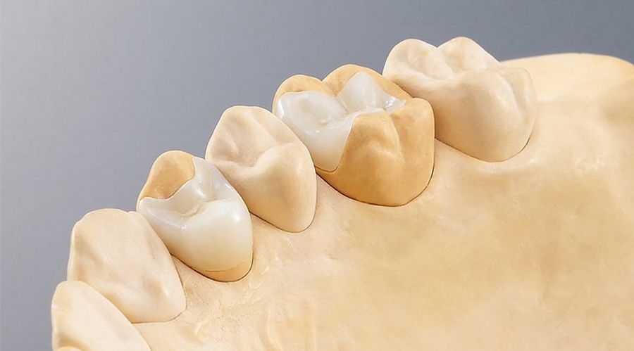 El sistema CEREC 3D de CAD-CAM dental permet confeccionar restauracions dentals amb una precisió d'ajust de 30 micres.