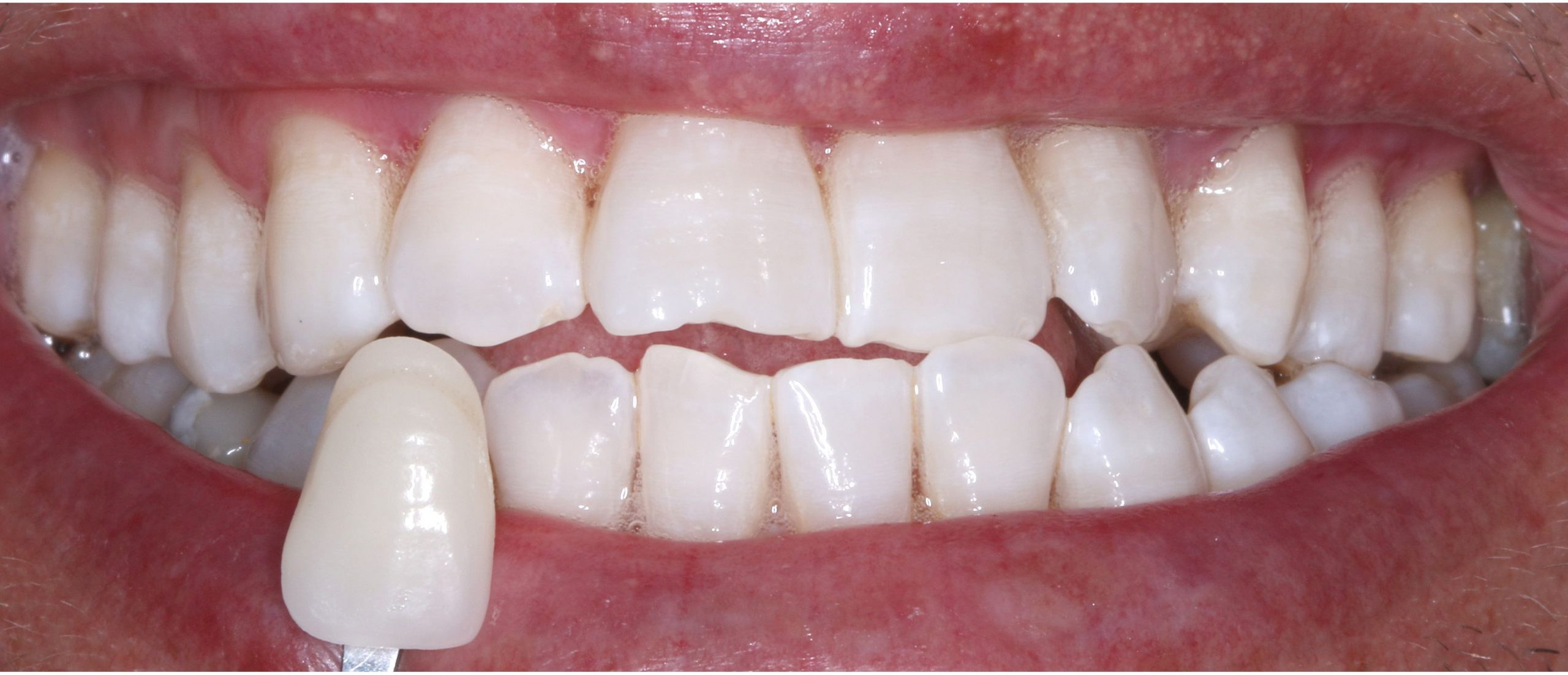 Tractament d'estètica emblanquiment dental. Clínica dental Padrós, dentista a Barcelona